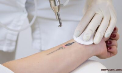 Tattoo Removal Practices