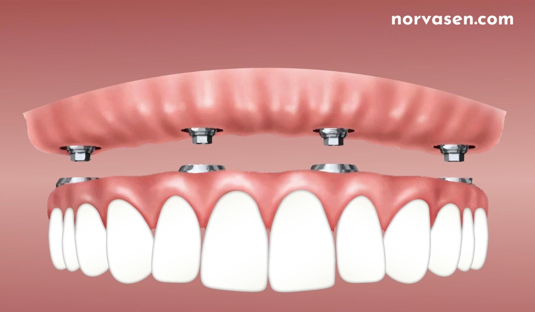 Front Dental Implants