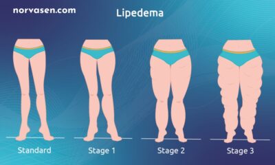 celebrities with lipedema