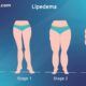 celebrities with lipedema