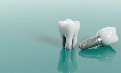 Dental Implants